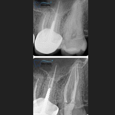 Root Canal - Before and After Root Canal - Before and After