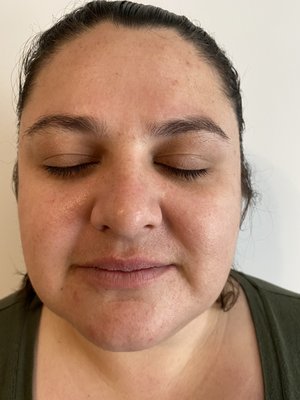 Micro Needling And Nano Needling - A new client came in and had my micro needling and nano needling treatment. The pictures show her before and immediately after. Micro Needling And Nano Needling - A new client came in and had my micro needling and nano needling treatment. The pictures show her before and immediately after.