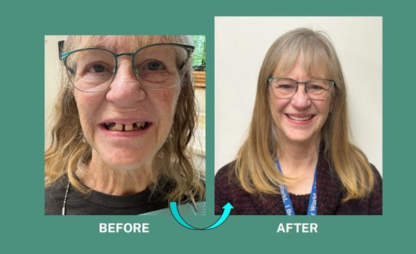 ⭐ Immediate Dentures: Walk In, Walk Out With a New Smile! - Dentures should not only accent the smile but should be superior in function to provide a better quality of life with excellent function. We value our work and strive to ensure every patient receives judgment free, top level care. From their first visit to 30 years down the road. Become a lifelong patient and love your smile again! "People who love their smile, smile more."" ⭐ Immediate Dentures: Walk In, Walk Out With a New Smile! - Dentures should not only accent the smile but should be superior in function to provide a better quality of life with excellent function. We value our work and strive to ensure every patient receives judgment free, top level care. From their first visit to 30 years down the road. Become a lifelong patient and love your smile again! "People who love their smile, smile more.""