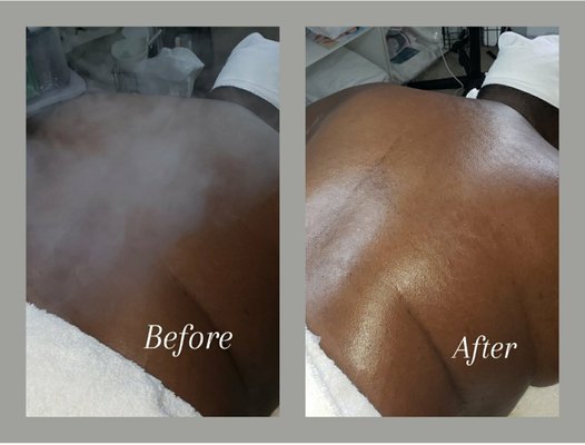 Back Facial (Bacial) Treatment - Back Facial treatment to cleanse, exfoliate, extract to help with clogged pores, back acne and dehydrated skin. Concludes a therapeutic mask with a relaxing neck, back and shoulder massage while steam towels on your legs for extra relaxation. Back Facial (Bacial) Treatment - Back Facial treatment to cleanse, exfoliate, extract to help with clogged pores, back acne and dehydrated skin. Concludes a therapeutic mask with a relaxing neck, back and shoulder massage while steam towels on your legs for extra relaxation.