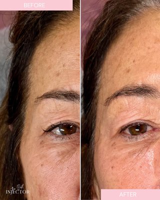 Temple Filler - Temple filler before and after showing subtle volume restoration and smoother forehead-to-cheek transition. Advanced facial balancing treatment in Delray Beach by an experienced injector. Temple Filler - Temple filler before and after showing subtle volume restoration and smoother forehead-to-cheek transition. Advanced facial balancing treatment in Delray Beach by an experienced injector.