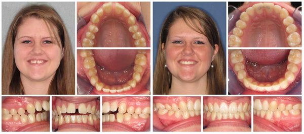 Invisalign - Invisalign offers a convenient and discreet alternative to traditional braces, allowing you to achieve a straighter smile with minimal disruption to your daily life. These revolutionary clear aligners are custom-made to fit snugly over your teeth, gradually and gently shifting them into their desired positions. Invisalign - Invisalign offers a convenient and discreet alternative to traditional braces, allowing you to achieve a straighter smile with minimal disruption to your daily life. These revolutionary clear aligners are custom-made to fit snugly over your teeth, gradually and gently shifting them into their desired positions.