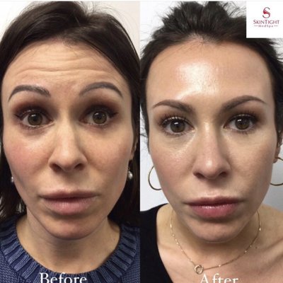 Botox Before and After - Before and after results of our patients who receive Botox. Our beautiful patients came in for a Botox treatment to erase forehead (frontalis muscles) wrinkles. The last patient also wanted to eliminate the wrinkles between his eyes (glabella muscles). After just one treatment, wrinkles and fine lines were decreased noticeably. Our patients were very satisfied with the results.  

Book a FREE consultation now at Skintight Medspa
732.859.0882/ 212.452.1235

We offer virtual consultations via FaceTime too!