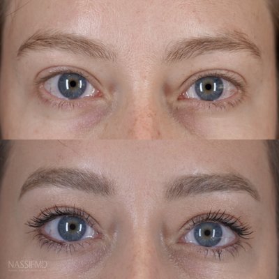 Microblading - Microblading is a semipermanent technique for enhancing the appearance of the eyebrows, in which pigment is scratched into the skin in fine, short strokes resembling hair, using a hand tool with a blade formed of tiny needles. Microblading - Microblading is a semipermanent technique for enhancing the appearance of the eyebrows, in which pigment is scratched into the skin in fine, short strokes resembling hair, using a hand tool with a blade formed of tiny needles.