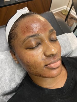 Microneedling - Experience rejuvenation with our advanced microneedling service using the Dr. Pen Q2 with a 25-needle cartridge. This cutting-edge treatment promotes collagen production and enhances skin texture by creating micro-injuries that stimulate the body's natural healing process. We tailor each session to address your specific skin concerns with custom serums, ensuring targeted and effective results. Whether you're looking to reduce fine lines, improve skin tone, or address acne scars, our personalized approach will help you achieve a radiant, youthful complexion.