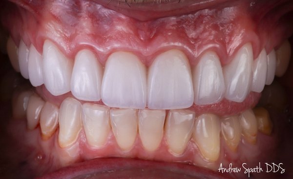 Refreshed Veneers in Newport Beach, CA - This individual had existing veneers that needed a refresher. The average length that veneers last when done under the correct conditions is approximately 20 years. With the new veneer material available and the talented ceramist we work with at Spath Dentistry the results we deliver with Veneers in Newport Beach, CA are quite nice. We anticipate the longevity and durability of our veneers to be much longer.