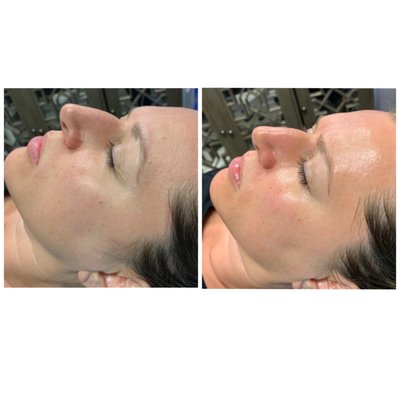 Hydrafacial - Unveil a radiant complexion with our cutting-edge treatment designed to cleanse, exfoliate, and hydrate your skin. Book now to experience the ultimate skincare rejuvenation and enjoy a special introductory rate. Hurry, this limited-time offer is your ticket to a glowing, refreshed look.