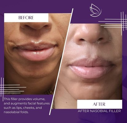 Dermal Fillers - A dermal filler is gel-like form of hyaluronic acid; a substance that is naturally occurring in skin and used in facial moisturizers. When injected into the skin at different depths, it helps fill in facial wrinkles, provide facial volume, and augment facial features including lips, cheeks and nasolabial folds: restoring a voluminous and smoother appearance. Dermal Fillers - A dermal filler is gel-like form of hyaluronic acid; a substance that is naturally occurring in skin and used in facial moisturizers. When injected into the skin at different depths, it helps fill in facial wrinkles, provide facial volume, and augment facial features including lips, cheeks and nasolabial folds: restoring a voluminous and smoother appearance.
