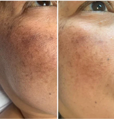 See real results with professional natural skin lightening - Professional Bryght skin brightening works on all skin tones because, unlike skin bleaching, it only targets EXCESS melanin that results in dark spots on the skin. This means that hyperpigmentation areas are lightened without lightening your natural skin tone, leaving an even glow that's 100% you. Most people see immediate results in the first session. 3 or more sessions may be required for optimal results in conjunction with recommended maintenance products. Skin areas include: bra and belt line, knees, elbows, ankles, face, neck, arm pits, stretch marks, tattoo removal scars, surgery scars, and self-harm scars. Products are safe for intimate areas. Request booking on our website. See real results with professional natural skin lightening - Professional Bryght skin brightening works on all skin tones because, unlike skin bleaching, it only targets EXCESS melanin that results in dark spots on the skin. This means that hyperpigmentation areas are lightened without lightening your natural skin tone, leaving an even glow that's 100% you. Most people see immediate results in the first session. 3 or more sessions may be required for optimal results in conjunction with recommended maintenance products. Skin areas include: bra and belt line, knees, elbows, ankles, face, neck, arm pits, stretch marks, tattoo removal scars, surgery scars, and self-harm scars. Products are safe for intimate areas. Request booking on our website.