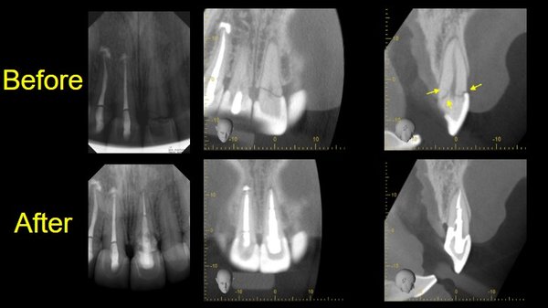 Traumatic Dental Injury - After experiencing trauma to their front tooth, this patient was able to save their tooth by seeing Peninsula Endodontics. Traumatic Dental Injury - After experiencing trauma to their front tooth, this patient was able to save their tooth by seeing Peninsula Endodontics.