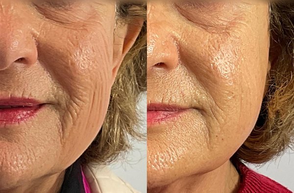 PDO Threads for mid-face and tear trough - If you're looking for a non-surgical way to combat wrinkles and tighten your skin, PDO collagen building threads might be just the thing for you!
PDO’s are made from a biocompatible material called polydioxanone. They create a mesh-like structure within the skin that supports and lifts sagging tissue. Over time, the PDO’s dissolve naturally, leaving behind firmer, smoother skin.
These photos show the immediate result achieved and will get better and better as the days go on. This session concentrated on her mid-face and tear trough. What a difference an hour makes!
If you're looking to give your skin a little pick-me-up, give PDO’s a try. Your skin (and your selfies) will thank you!
Book Your Appointment with Dr. Doris:
(310) 272-9988 PDO Threads for mid-face and tear trough - If you're looking for a non-surgical way to combat wrinkles and tighten your skin, PDO collagen building threads might be just the thing for you!
PDO’s are made from a biocompatible material called polydioxanone. They create a mesh-like structure within the skin that supports and lifts sagging tissue. Over time, the PDO’s dissolve naturally, leaving behind firmer, smoother skin.
These photos show the immediate result achieved and will get better and better as the days go on. This session concentrated on her mid-face and tear trough. What a difference an hour makes!
If you're looking to give your skin a little pick-me-up, give PDO’s a try. Your skin (and your selfies) will thank you!
Book Your Appointment with Dr. Doris:
(310) 272-9988