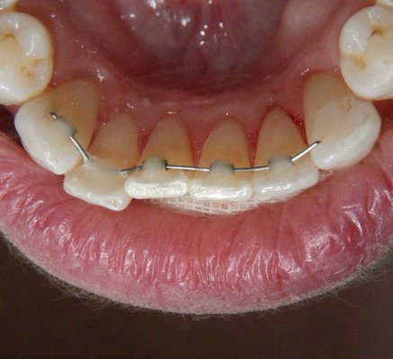 Q-Tube Lingual Technique - Straighten your teeth with invisible braces placed behind your teeth. No removable aligner wear needed. Q-Tube Lingual Technique - Straighten your teeth with invisible braces placed behind your teeth. No removable aligner wear needed.