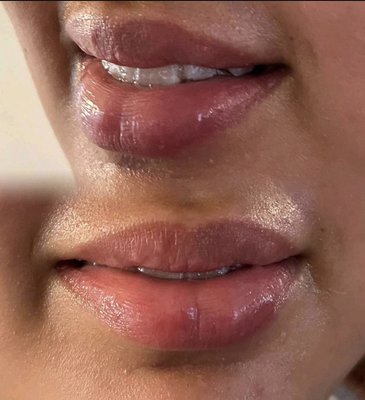 Hyaluronic Lip Filler - Before and after hyaluronic lip filler done by my student 🙌
✨hyaluron lip filler course available✨
#hyaluronicacid #hyaluronpen #lipfillertraining #houstontx Hyaluronic Lip Filler - Before and after hyaluronic lip filler done by my student 🙌
✨hyaluron lip filler course available✨
#hyaluronicacid #hyaluronpen #lipfillertraining #houstontx