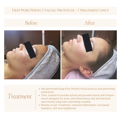 Acne Deep Pore Perfect Facial with Micro channeling - Acne treatment results in just 1 session - Deep Pore Perfect Facial with nano/micro channeling.
We performed Deep Pore Perfect Facial protocol and performed extractions.
Then, a blend of powder actives and powder bends with infusion serum designed for acne, anti-inflammatory and anti-bacterial was infused using nano-channeling modality.
Results: In just 1 treatment, reduced inflammation, increased hydration, skin tone brightened Acne Deep Pore Perfect Facial with Micro channeling - Acne treatment results in just 1 session - Deep Pore Perfect Facial with nano/micro channeling.
We performed Deep Pore Perfect Facial protocol and performed extractions.
Then, a blend of powder actives and powder bends with infusion serum designed for acne, anti-inflammatory and anti-bacterial was infused using nano-channeling modality.
Results: In just 1 treatment, reduced inflammation, increased hydration, skin tone brightened