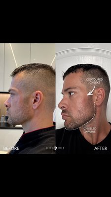 Male Facial Sculpting with Threads - Our patient made a positive lifestyle change and has been hitting the gym hard. He has seen some laxity to the skin on his face due to weight loss, so he's here today to receive threads to rejuvenate his face with the strongest hold around. We are the experts in this unique and incredible technique - delivering impressive results, with no downtime.