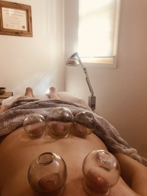 Immediate Pain Relief - Got pain--no problem! Let us use cutting edge science and ancient tried-and-true methods to bring you back to health and wellness!

Cupping is an immediate way to experience relief in muscles that are tight, spasmed or achey. Cupping is amazing for pain and discomfort in the upper and lower back and wonderful for people in athletic training, as it helps the muscles recover faster. 

Cupping is a natural medical therapy that infuses your muscles with fresh blood flow and oxygen, through a non-invasive technique. 

Cupping used with movement, called "Running Cupping", is also a great way to help reset the muscular tissue upon the skeletal system in the right way. (When muscles have been in spasm they can start pulling and resting upon the skeleton in ways that can cause further pain and damage). This can shift scoliosis in its tracks and completely change the health of your spine for the rest of your life!

You may have seen the purple circle marks by olympic athletes such as Michael Phelps. It feels wonderful and provides immediate relief. 

Acupuncture works more deeply, within the electrical wiring of your body--to bring your body back to its highest functioning potential. 

We use diagnostic tools to visually show you where things are either stagnant from too much energy in a channel (think of it as an energy highway) seen as red bars in the graph image chart example, or too little energy (think of a river that gets gunky due to not enough water flow) which is blue in the graph chart. We also see the areas of the spine that could be affected by how your energy is currently moving in your body.

We then customize a treatment protocol, geared specifically for your body, to shift your the electrical flow in a way that will bring you relief in many areas. 

Most patients come in due to pain somewhere, but as we are balancing your energy highways (meridians) patients often experience a more positive and happy mindset, deeper sleep, increased sexual function, as well as better digestion and bowel movements. 

We carry the highest quality acupuncture tools that do not cause pain--oftentimes patients can't even feel them and it is always a joy to see how much relief they have after the treatment. 

This work is sacred to me and my team. Not only our location, along the creek and its history with our native tribes, but the heartbeat that my team carries in their hearts and hands for our people here in Sonoma Valley. 

Looking forward to connecting with you about how I, or my team, can best assist you. 

~*~I offer free consultations as well, and I love talking about this medicine! Give a call, or send a message, anytime for questions or about what you are struggling with and I would be happy to assist you to see if we are a match for your healing journey. ~*~