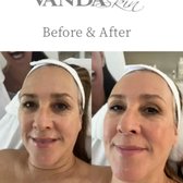 8 Steps to a younger you. Microhydralift exfoliates the build up of dead skin cells, oxygenates the skin, & softens the lines & wrinkles.