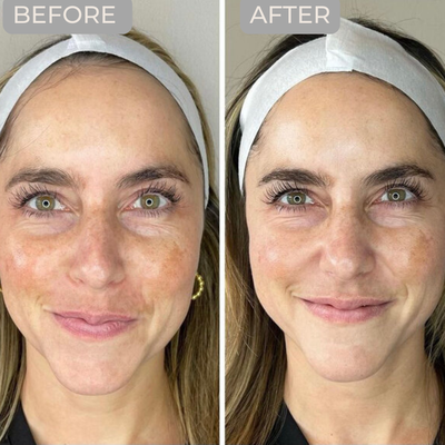 Chemical Peels - Dead skin cells are piling up every day. Remove aging skin cells and let the fresh skin underneath be revealed. VI chemicals have several formulations for all skin types, and improve many skin concerns including acne, hyperpigmentation, fine lines, and uneven texture. Chemical Peels - Dead skin cells are piling up every day. Remove aging skin cells and let the fresh skin underneath be revealed. VI chemicals have several formulations for all skin types, and improve many skin concerns including acne, hyperpigmentation, fine lines, and uneven texture.