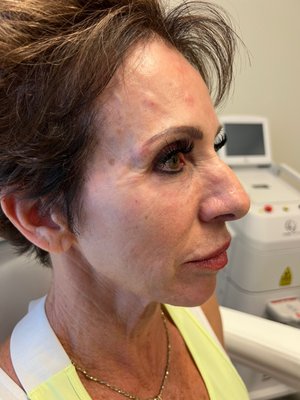 Under Eye Filler - Juvederm products are not just for lips and cheeks. Our clients have seen wonderful results and improvements when used under the eyes to give them a refreshed look. Under Eye Filler - Juvederm products are not just for lips and cheeks. Our clients have seen wonderful results and improvements when used under the eyes to give them a refreshed look.