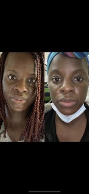 Acne treatment - My Clients and achieve this beautiful result after few sessions of acne treatments! Acne treatment - My Clients and achieve this beautiful result after few sessions of acne treatments!