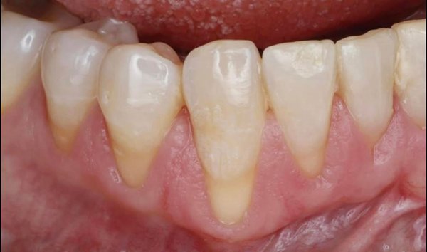 Periodontal Surgery, Before & After - We offer Periodontal graft surgery to treat receding gums & teeth sensitivity. Improve your smile today!
