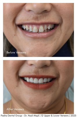 Veneer Transformations 2025 - In these photos are two different patients, who each received veneers with incredible results! Veneer Transformations 2025 - In these photos are two different patients, who each received veneers with incredible results!