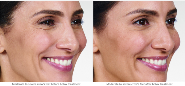 Crow's Feet Botox Before and After - As we become older, bothersome signs of sun-damage, genetics, and aging are inevitable. Fine lines and wrinkles can have an adverse effect on how people perceive us, as well as, our self-image. Consequently, every aspect of our lives from work to social events can trigger anxiety.
If this sounds familiar, you’re not alone. Millions of Americans request BOTOX® Cosmetics to treat their aesthetic concerns. In fact, BOTOX® Cosmetics remains the number one non-surgical procedure asked for on the market today.
Call today to schedule your free consultation! Crow's Feet Botox Before and After - As we become older, bothersome signs of sun-damage, genetics, and aging are inevitable. Fine lines and wrinkles can have an adverse effect on how people perceive us, as well as, our self-image. Consequently, every aspect of our lives from work to social events can trigger anxiety.
If this sounds familiar, you’re not alone. Millions of Americans request BOTOX® Cosmetics to treat their aesthetic concerns. In fact, BOTOX® Cosmetics remains the number one non-surgical procedure asked for on the market today.
Call today to schedule your free consultation!