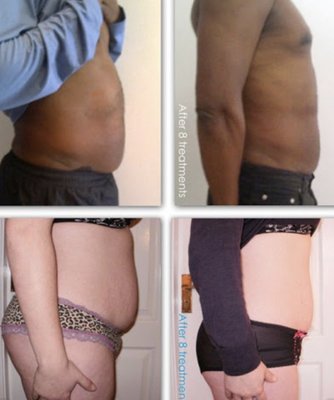 SUMMER BODIES ARE MADE IN WINTER - Customer have received 8 lipo treatments
**** Results vary SUMMER BODIES ARE MADE IN WINTER - Customer have received 8 lipo treatments
**** Results vary