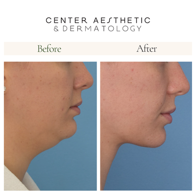 Chin LipoSculpting - Double Chin Liposuction
Excess fat is removed from your chin, making your face look thinner and more defined. A chin that is holding onto unwanted fat deposits creates a less flattering profile, a weaker jawline and folds that are frustrating to the individual who is seeking a smoother, more contoured appearance. Dr. Cheryl Karcher can safely and effectively reduce a double chin significantly in just one treatment. With minimal downtime, her method provides a safe and effective result for both men and women alike, right here in our Union Square practice. Chin LipoSculpting - Double Chin Liposuction
Excess fat is removed from your chin, making your face look thinner and more defined. A chin that is holding onto unwanted fat deposits creates a less flattering profile, a weaker jawline and folds that are frustrating to the individual who is seeking a smoother, more contoured appearance. Dr. Cheryl Karcher can safely and effectively reduce a double chin significantly in just one treatment. With minimal downtime, her method provides a safe and effective result for both men and women alike, right here in our Union Square practice.