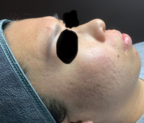 Microneedling Treatment - This is the before/after pic of this sweet girl who had some acne scarring.
