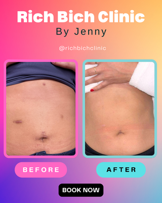 Gastric Bypass Surgery Scar Removal - This took 6-8 sessions at 275.00 per session totaling 1650-2,200.00
Every session was 3-4 weeks apart and each session the client paid 275.00. I charge per session because you may need more or less than what I estimate. Gastric Bypass Surgery Scar Removal - This took 6-8 sessions at 275.00 per session totaling 1650-2,200.00
Every session was 3-4 weeks apart and each session the client paid 275.00. I charge per session because you may need more or less than what I estimate.