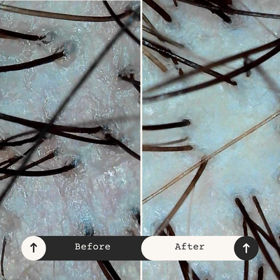 Head Spa 60 Minute Alchemist Treatment - Using Tricoscope scalp technology for a microscopic evaluation; this shows the scalp before and after 1 60-Minute BESPOKE Head Spa treatment. Achieving a balanced scalp pH and clean hair follicles is key to unlocking healthy volume and promoting hair regrowth.

Head spa treatments and appropriate at-home care is incredibly valuable from a health and hair regrowth perspective.  Maintaining the scalp's natural pH of 4.5–5.5 is essential for hair health and growth – as the proper balance defends against bacteria/fungi/irritants and regulates oil production. The scalp ages up to 6X faster than facial skin making it prone to thinning and irritation. Rich in blood vessels, the scalp responds to massage, as it boosts circulation thus aiding nutrient delivery while relieving tension headaches, migraines, and sinus pressure.

Due to this; best case scenario we recommend coming in every 2-4 weeks. The benefits: Exfoliating removes dead skin cells from the scalp, which can help unclog hair follicles and promote healthy hair growth. There are considerations based on scalp type; lifestyle etc; for instance oily scalp may tolerate more frequent exfoliation and dry or sensitive scalp should exfoliate less often to avoid irritation.