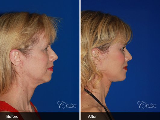 Full Facial Rejuvenation at 49 — Facelift, Neck Lift, Brow Lift, Eyelid Surgery & Fat Transfer - "I initially only wanted a neck lift." Carin, 49, came to Dr. Cruise for neck rejuvenation, one of the most common ways facelift patients begin their journey. During her consultation, Dr. Cruise explained honestly that her neck was only part of the picture: the face ages as a unit, and treating the neck alone can create a mismatched result where a rejuvenated neck sits beneath an aging midface, brow, and eyes.
Why do surgeons recommend a full facelift instead of just a neck lift? Because natural results come from harmony. After discussing her goals, Carin chose full facial rejuvenation: a facelift with neck lift, brow/temple lift, upper and lower eyelid surgery, chin augmentation, and fat transfer, each customized to her anatomy. The procedure was performed under general anesthesia, and her photographs show results at 6 months.
In her words: "This is the best money I have spent in my life. I appreciated his honesty about how my whole face was aging, not just my neck. Since the surgery, I am more confident and feel like I can do everything I did in my 20s. I have the perfect natural look. I now look on the outside how I feel on the inside; more vibrant, more alive, more like me!"
Dr. Cruise is a facelift specialist and author of "Aging on Your Terms," his book on natural facial rejuvenation: restoring how you were meant to look, not what aging has changed. Every facial rejuvenation plan is customized after an in-depth consultation. Full Facial Rejuvenation at 49 — Facelift, Neck Lift, Brow Lift, Eyelid Surgery & Fat Transfer - "I initially only wanted a neck lift." Carin, 49, came to Dr. Cruise for neck rejuvenation, one of the most common ways facelift patients begin their journey. During her consultation, Dr. Cruise explained honestly that her neck was only part of the picture: the face ages as a unit, and treating the neck alone can create a mismatched result where a rejuvenated neck sits beneath an aging midface, brow, and eyes.
Why do surgeons recommend a full facelift instead of just a neck lift? Because natural results come from harmony. After discussing her goals, Carin chose full facial rejuvenation: a facelift with neck lift, brow/temple lift, upper and lower eyelid surgery, chin augmentation, and fat transfer, each customized to her anatomy. The procedure was performed under general anesthesia, and her photographs show results at 6 months.
In her words: "This is the best money I have spent in my life. I appreciated his honesty about how my whole face was aging, not just my neck. Since the surgery, I am more confident and feel like I can do everything I did in my 20s. I have the perfect natural look. I now look on the outside how I feel on the inside; more vibrant, more alive, more like me!"
Dr. Cruise is a facelift specialist and author of "Aging on Your Terms," his book on natural facial rejuvenation: restoring how you were meant to look, not what aging has changed. Every facial rejuvenation plan is customized after an in-depth consultation.