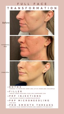 Full face transformation - The best results come from combination treatments. Visit us for a consultation to see how we can best meet your needs! Full face transformation - The best results come from combination treatments. Visit us for a consultation to see how we can best meet your needs!