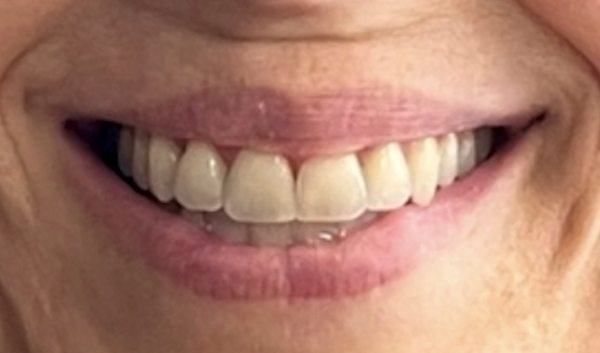 Smile Transformation with Invisalign - Orthodontic treatment done with Invisalign. Transform your smile by aligning your teeth and bite, with minimal aesthetic contouring of your natural teeth. No bondings or veneers needed. Smile Transformation with Invisalign - Orthodontic treatment done with Invisalign. Transform your smile by aligning your teeth and bite, with minimal aesthetic contouring of your natural teeth. No bondings or veneers needed.