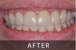 10 Anterior Veneers from Kennewick Dental - Client all smiles and confident again after receiving 10 veneers at Kennewick Dental 10 Anterior Veneers from Kennewick Dental - Client all smiles and confident again after receiving 10 veneers at Kennewick Dental