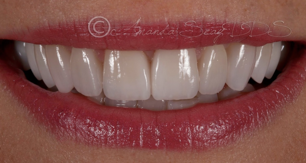 Smile Makeovers - Smile Like You Used To
With Our Porcelain Veneers
Veneers are very thin porcelain pieces that are custom made to adhere directly to the front of teeth without grinding or shaving. Transform your smile without drilling on your natural teeth!
In the hands of a highly skilled dentist, porcelain laminates can provide you with an incredibly natural, beautiful smile. They are virtually undetectable and can dramatically improve your appearance. They are durable and long-lasting when compared to other cosmetic treatments. Smile Makeovers - Smile Like You Used To
With Our Porcelain Veneers
Veneers are very thin porcelain pieces that are custom made to adhere directly to the front of teeth without grinding or shaving. Transform your smile without drilling on your natural teeth!
In the hands of a highly skilled dentist, porcelain laminates can provide you with an incredibly natural, beautiful smile. They are virtually undetectable and can dramatically improve your appearance. They are durable and long-lasting when compared to other cosmetic treatments.
