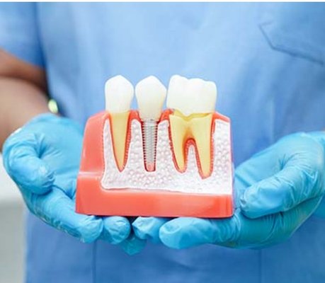 DENTAL IMPLANTS - A dental implant serves as an artificial root, firmly anchored into the jawbone that supports a fixed or removable tooth replacement. This is one of the strongest methods for replacing a damaged or missing tooth. It acts like your natural tooth and support your individually made porcelain crown, bridge or full prosthesis.
One of the greatest benefits of a dental implant is strength. The post or screw of a dental implant is made out of titanium. Due to the properties of this super-strong material, your body does not recognize it as a foreign object. This means that when a dental implant is put into place, your jawbone actually grafts itself to the titanium post making it just as strong as the original tooth and root. DENTAL IMPLANTS - A dental implant serves as an artificial root, firmly anchored into the jawbone that supports a fixed or removable tooth replacement. This is one of the strongest methods for replacing a damaged or missing tooth. It acts like your natural tooth and support your individually made porcelain crown, bridge or full prosthesis.
One of the greatest benefits of a dental implant is strength. The post or screw of a dental implant is made out of titanium. Due to the properties of this super-strong material, your body does not recognize it as a foreign object. This means that when a dental implant is put into place, your jawbone actually grafts itself to the titanium post making it just as strong as the original tooth and root.