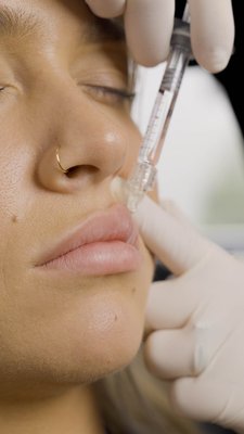 Naked Lips | Lip Filler - Enhance volume, symmetry, and hydration while reducing fine lines and maintaining a full range of expression. Our Artist Injectors will do a thorough evaluation to discuss what is needed for you to achieve your desired result and educate if more than one syringe over a course of time is necessary to reach your goal. Naked Lips | Lip Filler - Enhance volume, symmetry, and hydration while reducing fine lines and maintaining a full range of expression. Our Artist Injectors will do a thorough evaluation to discuss what is needed for you to achieve your desired result and educate if more than one syringe over a course of time is necessary to reach your goal.