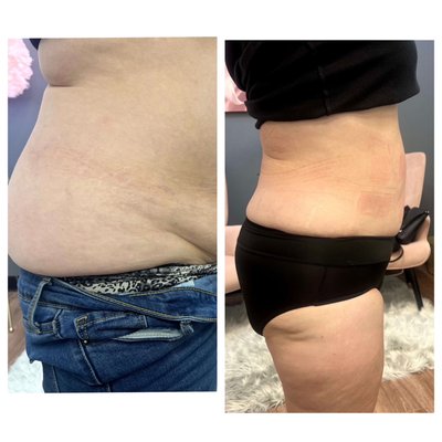 ice21 Better than Coolsculpting - This revolutionary technology is the number one fat freezing met Method in the world. It freezes fat while it stimulates muscle and does a complete body lymphatic drainage all at the same time while you burn over 5000 cal in one session! You lose the fat in three weeks instead of like cool sculpting that takes three months to lose the fat from each session. Be ready to be amazed, and it will change your life! ice21 Better than Coolsculpting - This revolutionary technology is the number one fat freezing met Method in the world. It freezes fat while it stimulates muscle and does a complete body lymphatic drainage all at the same time while you burn over 5000 cal in one session! You lose the fat in three weeks instead of like cool sculpting that takes three months to lose the fat from each session. Be ready to be amazed, and it will change your life!