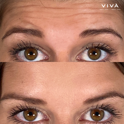 Botox Injections | Round Rock - Looking for the ultimate wrinkle eraser, Botox in downtown Round Rock? You’ve found it. FDA-cleared Botox Cosmetic is a minimally invasive cosmetic injectable that softens moderate to severe facial lines and wrinkles that develop as we age. That’s why it is often referred to as a “wrinkle relaxer.” In fact, Botox injections will not dramatically change your facial appearance.
Instead, you’ll see results that are natural looking and striking within a few days after your Round Rock Botox treatment at Viva Day Spa + Med Spa. The muscles in your face are simply relaxed, so you can still frown, smile or look surprised without those pesky wrinkles and creases. Plus, it helps prevent lines and wrinkles from deepening over time. Botox Injections | Round Rock - Looking for the ultimate wrinkle eraser, Botox in downtown Round Rock? You’ve found it. FDA-cleared Botox Cosmetic is a minimally invasive cosmetic injectable that softens moderate to severe facial lines and wrinkles that develop as we age. That’s why it is often referred to as a “wrinkle relaxer.” In fact, Botox injections will not dramatically change your facial appearance.
Instead, you’ll see results that are natural looking and striking within a few days after your Round Rock Botox treatment at Viva Day Spa + Med Spa. The muscles in your face are simply relaxed, so you can still frown, smile or look surprised without those pesky wrinkles and creases. Plus, it helps prevent lines and wrinkles from deepening over time.