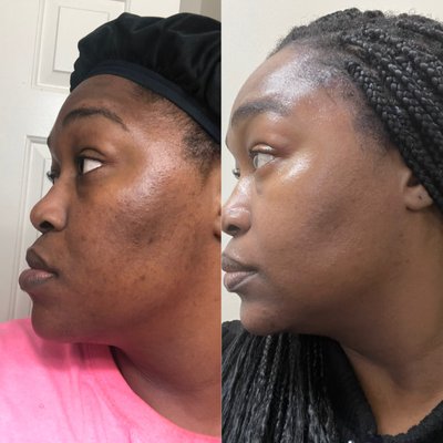 Hyperpigmentation - Safely reducing hyperpigmentation without any down time. Hyperpigmentation - Safely reducing hyperpigmentation without any down time.