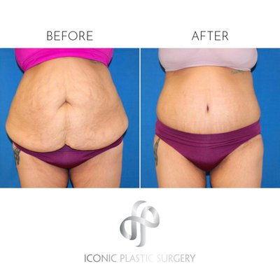 Tummy Tuck - Tummy Tuck before and after photos. Tummy Tuck - Tummy Tuck before and after photos.