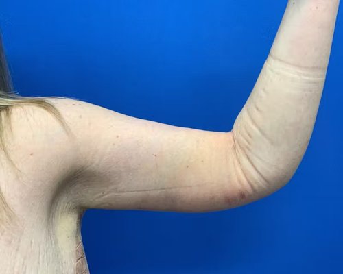 Arm Lift - Arm lift (brachioplasty) by Dr. Gavin Dry. 44 year old female patient. Post-op images were captured at 1 month. Arm Lift - Arm lift (brachioplasty) by Dr. Gavin Dry. 44 year old female patient. Post-op images were captured at 1 month.