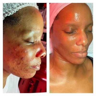 Skincare - We use high quality pharmaceutical grade products to get you the great predictable results! Skincare - We use high quality pharmaceutical grade products to get you the great predictable results!