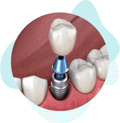 Check out our Signature Services! - 1) Severely decayed or missing teeth need never again cause you pain and embarrassment. Dental implants—today’s foremost tooth replacement method—feel, look, and perform just like natural teeth and can last a lifetime with proper care

2) No more waiting weeks for dental crowns. With CEREC technology, we can custom-design, fabricate, and place your new crowns during a single appointment. Dr. Stephen Hamelburg was among the first practitioners to use this revolutionary technology back in the 1990s.

3) We no longer need to remove pieces of your gum tissue to reverse gum recession. With the groundbreaking Pinhole Surgical Technique, we can simply reposition your existing tissue. No scalpels or stitches are needed. The procedure is even incision-free!