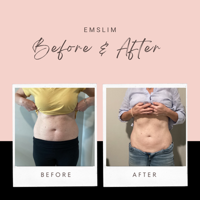 EmSlim Body Sculpting - EmSlim is similar to EmSculpt (as seen on the Kardashians) Cutting-edge electromagnetic technology meets transformative body sculpting. Our innovative procedure induces powerful muscle contractions that go beyond what you can achieve through exercise, enhancing muscle tone and reducing fat in targeted areas. Whether you're looking at your abs, buttocks, thighs, or arms, EmSlim is here to help you achieve that sculpted physique you've always wanted. Experience the difference and embrace a more contoured appearance with EmSlim today. EmSlim Body Sculpting - EmSlim is similar to EmSculpt (as seen on the Kardashians) Cutting-edge electromagnetic technology meets transformative body sculpting. Our innovative procedure induces powerful muscle contractions that go beyond what you can achieve through exercise, enhancing muscle tone and reducing fat in targeted areas. Whether you're looking at your abs, buttocks, thighs, or arms, EmSlim is here to help you achieve that sculpted physique you've always wanted. Experience the difference and embrace a more contoured appearance with EmSlim today.