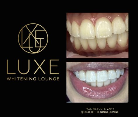 Before & Afters of professional teeth whitening at LUXE Whitening Lounge - LUXE teeth whitening before and afters. After ONE 30 minute session! Before & Afters of professional teeth whitening at LUXE Whitening Lounge - LUXE teeth whitening before and afters. After ONE 30 minute session!