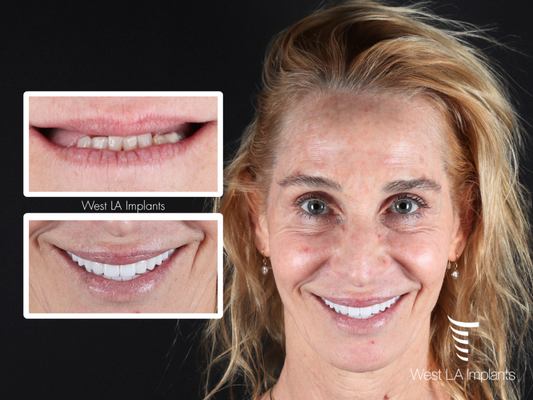 Full-Arch Patient Case Spotlights - See how All-on-X dental implants transformed our patients’ smiles, confidence, and quality of life. Each treatment was carefully customized to restore a natural-looking, functional smile with long-lasting results. Schedule a consultation to discover what’s possible for you. Full-Arch Patient Case Spotlights - See how All-on-X dental implants transformed our patients’ smiles, confidence, and quality of life. Each treatment was carefully customized to restore a natural-looking, functional smile with long-lasting results. Schedule a consultation to discover what’s possible for you.