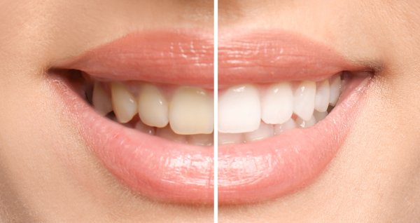 Teeth Whitening - We provide in-office teeth whitening service which brings out your true smile! Teeth Whitening - We provide in-office teeth whitening service which brings out your true smile!